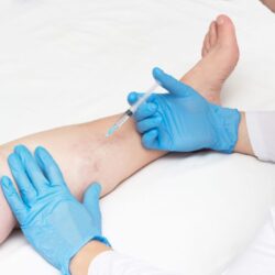 Copy-of-Sclerotherapy-shutterstock_1283406964-scaled