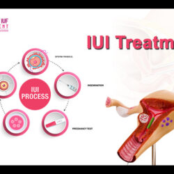 IUI Treatment (1)
