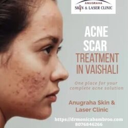 Acne scar treatment in Vaishali