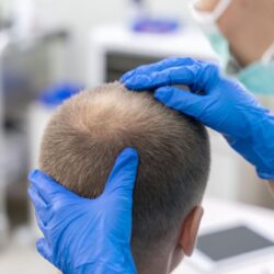 Permanent Hair Transplant Cost in Rajasthan