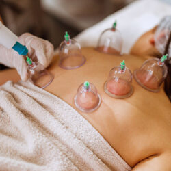 16554-cupping-therapy