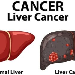 Liver Cancer (2)