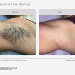 IPL_Hair_Removal_Before_After-1024x784