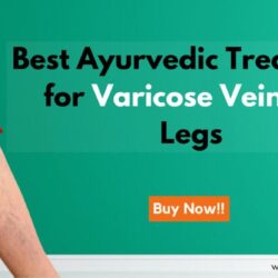 Varicose veins on Legs