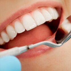 Dentist Wisdom Teeth