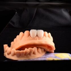 full-ceramic-crowns-mega-dental-1